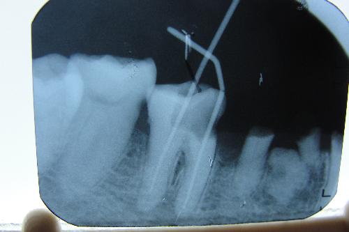 根管治療多少錢