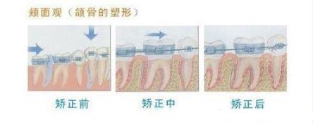 深圳做牙齒矯正多少錢