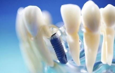 一顆種植牙多少錢