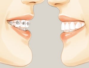 牙齒矯正多少錢