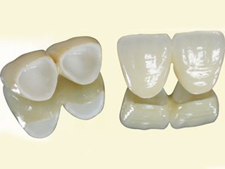 美容冠矯正牙齒