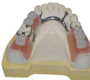 活動假牙需要磨鄰牙嗎