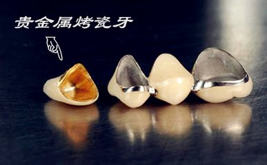 貴金屬烤瓷牙
