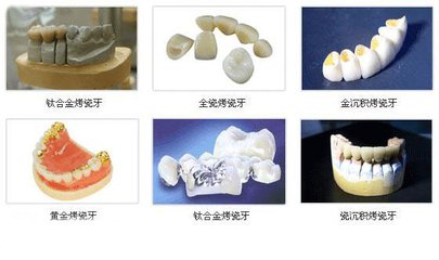 烤瓷牙要怎麽(me) 選擇