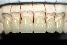 鈀金合金烤瓷牙多少錢