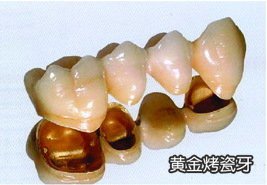 貴金屬烤瓷牙