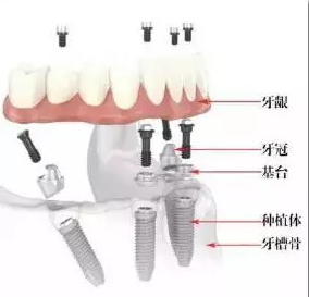 種植牙後帶牙冠