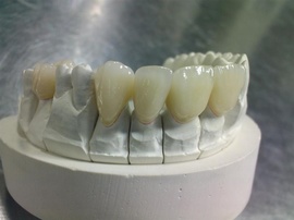 鈦合金烤瓷牙的危害