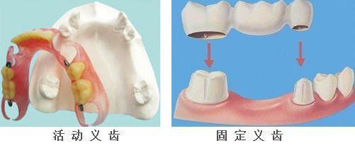 固定義(yi) 齒和活動義(yi) 齒