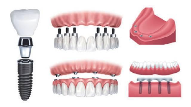 固定義(yi) 齒和活動義(yi) 齒的區別