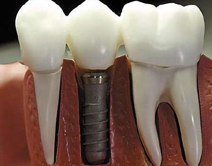 種植牙的年齡限製