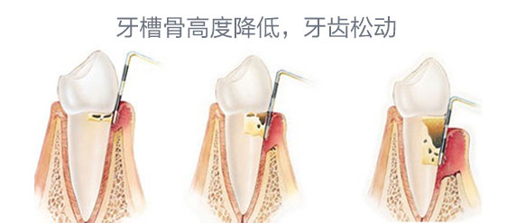 引起牙齒鬆動的原因