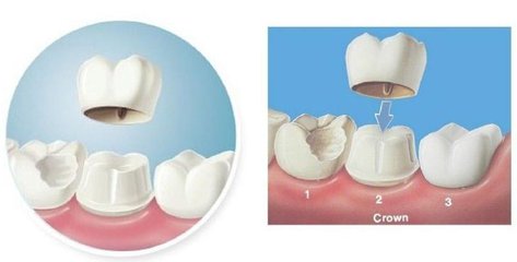 快速牙齒美容多少錢