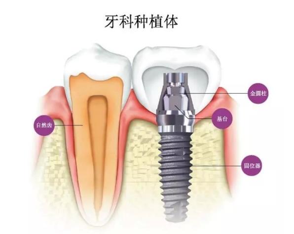 牙齒種植價(jia) 格