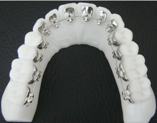 牙齒矯正器要多少錢