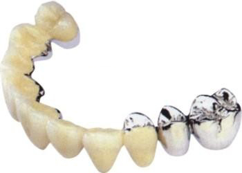 鈦合金烤瓷牙價(jia) 格表