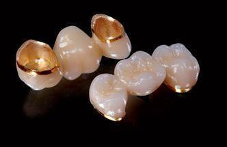 貴金屬烤瓷牙的危害