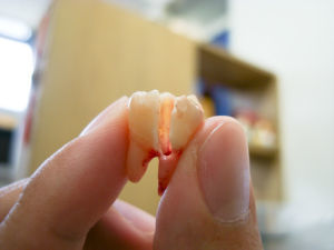 鬆動的牙齒拔牙要多少錢