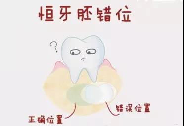 乳牙滯留怎麽(me) 辦