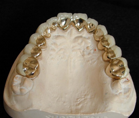 烤瓷牙用什麽(me) 材料好