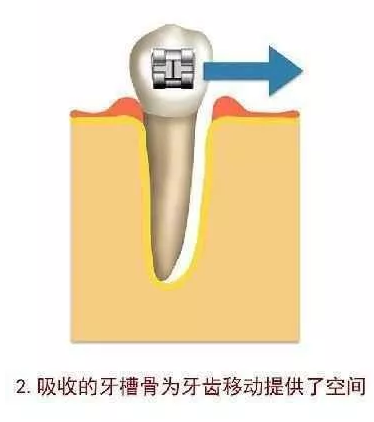 矯正牙牙齒鬆動