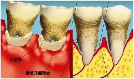 牙齦萎縮能恢複嗎