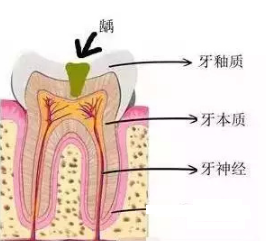 蛀牙沒有黑洞要補牙嗎