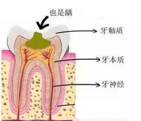 蛀牙沒有洞要補牙嗎