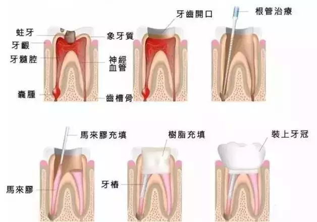根管治療後牙齒能用幾年