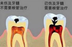 根管治療後牙齒能用幾年
