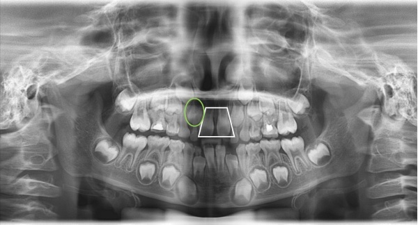 孩子的門牙牙縫大怎麽(me) 辦
