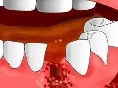 拔完牙不能吐口水嗎