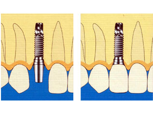 奧齒泰種植牙多少錢