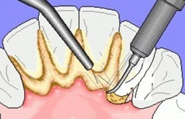超聲波洗牙注意事項