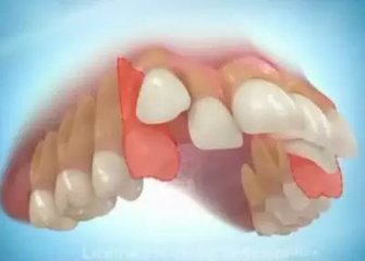 矯正牙齒拔牙