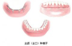 全口種植牙要多少錢