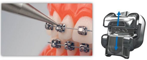 自鎖托槽矯正器