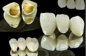 鈦合金烤瓷牙價(jia) 格