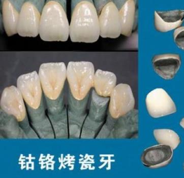 鈷鉻合金烤瓷牙的結果