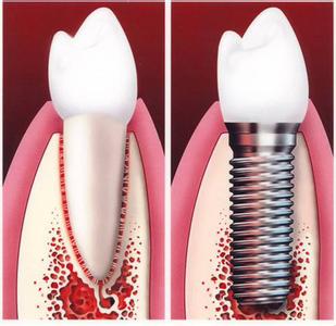 人工種植牙費用多少
