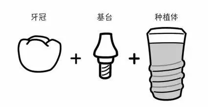 人工種植牙費用