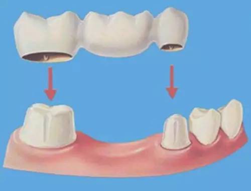 修複一顆牙齒多少錢
