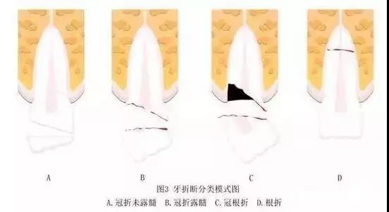 牙齒斷了怎麽(me) 修複