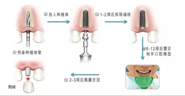 種植牙術後注意事項