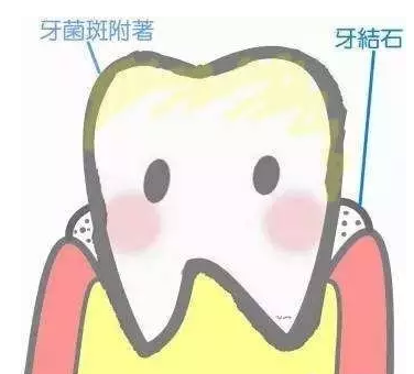 牙結石是怎麽(me) 形成的