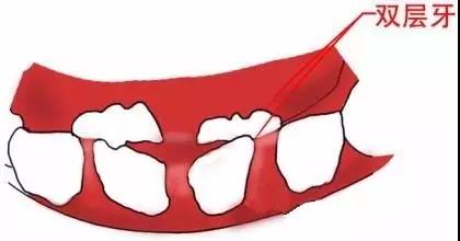 乳牙沒掉長新牙