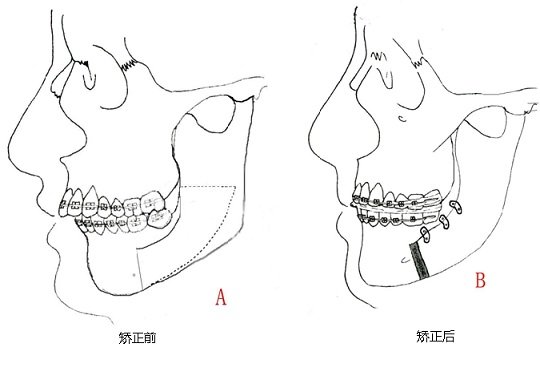 牙齒矯正手術多少錢