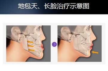 牙齒矯正手術價(jia) 格