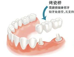 拔牙後鑲牙還是種牙