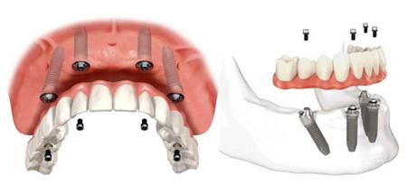 種牙價(jia) 格多少錢一顆